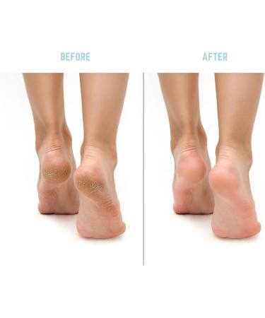 PediCurve Electric Callus Remover | Unique Callus Remover Gently Removes Callus Remover Electric Callus Remover via Solar Cells or with USB - Buy Online on GoSupps.com