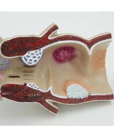 Humanly Rectal Hemorrhoid Lesions Anatomical Model Dilkpunkt Anal Anorectal - Buy Online on GoSupps.com