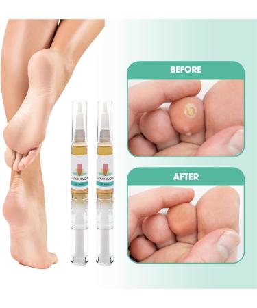 Inadine Wart Remover - Quick & Safe Treatment for All Skin Types - 2-in-1 Wart & Verruca Remover - Natural & Safe - 2 Pens per Box - Buy Online on GoSupps.com