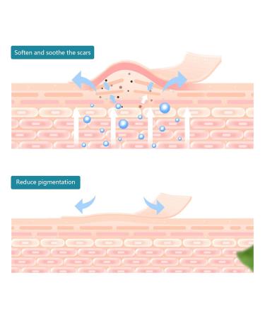 Hypoallergenic Silicone Scar Strips for Hyperplastic Scars - Waterproof & Breathable - Ideal for Women - Home & Travel Use - Buy Online on GoSupps.com