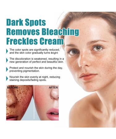 Dark Spot Correcting Serum - Best Dark Spot Remover for Age Spots Sun Spots & Freckles - 30g Body Cream - Buy Online on GoSupps.com