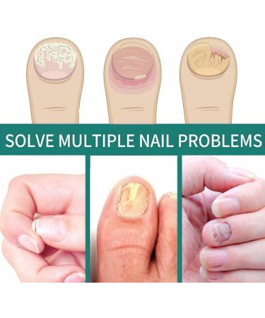 Toenail Fungus Treatment - Nail Fungus Treatment for Toenail - Anti Fungal Nail Treatment for Thickening Yellow - Brown Discoloration - Fast Extra Strong Nail Repair Solution - Buy Online on GoSupps.com