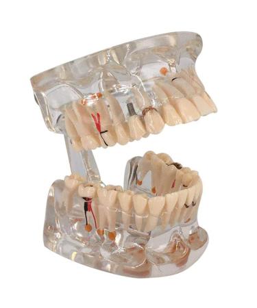DYTAH Transparent Teeth Model Pathological Tooth with Removable Teeth for Dental Examination and Training
