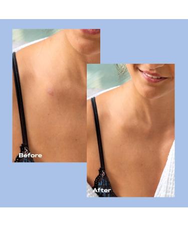 KAMEDIS Anti-Itch & Bug Bite Calming Lotion - Soothes Moisturizes & Relieves Skin Irritation | International Shipping Available - Buy Online on GoSupps.com
