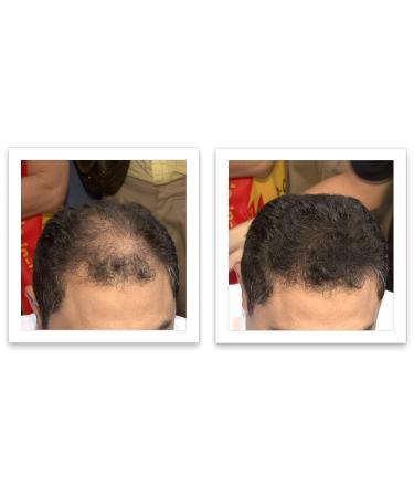Caboki Hair Loss Concealer - All-Natural Hair Building Fiber for Fuller Hair. Cover Bald Spots and Thinning Areas. Dark Brown (30g) - Buy Online on GoSupps.com