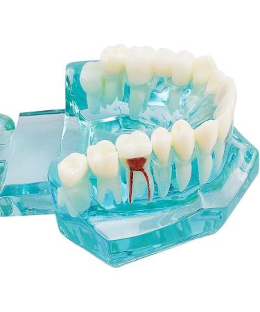 Buy Lmeil Transparent Dental Teeth Model - Ideal for Implantation & Dentist Research | Pathological Dental Model - Buy Online on GoSupps.com