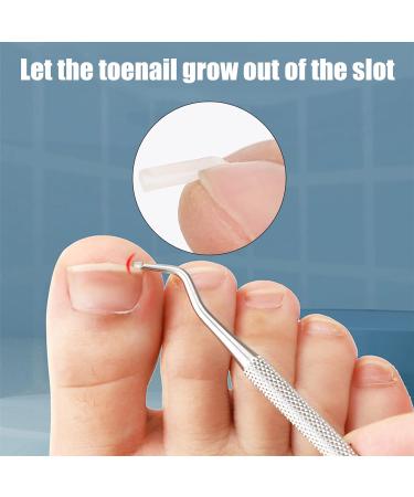 52 Pcs Ingrown Toenail Correction Strips Brace Kit Ingrown Toenail Corrector Toenail Correction Patches Ingrown Toenail Treatment Toenail Straightener Strips with Nail Clipper for Women Men Foot Care - Buy Online on GoSupps.com