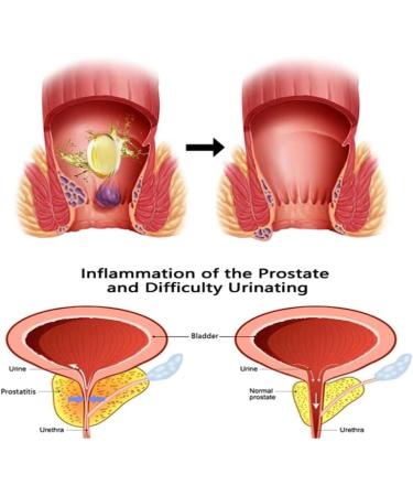 PINNKL Heca Natural Herbal Hemorrhoid Capsules - Rapid Relief Suppository Treatment (3PCS) - Buy Online on GoSupps.com