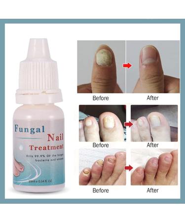 Bright Nail Repair | Best Toenail Fungus Treatment | 10 mL - Fast & Effective Infection Relief - Buy Online on GoSupps.com