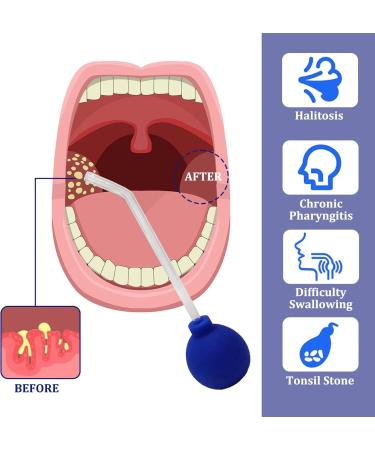 Effective Tonsil Stone Remover - Living & Leben Cupping Glass for Tonsil Care - Buy Online on GoSupps.com