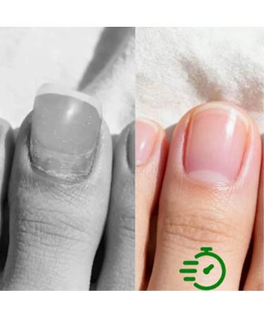  Generisch Hyaluronic Acid Nail Care with Vitamin E and Jojoba Oil - Intensive Moisturizing Treatment for Nails and Cuticles - Nail Care and Nail Polish - Buy Online on GoSupps.com