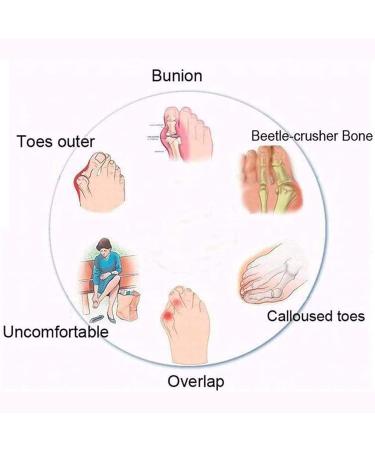 Buy Summer Orthopedic Sandals for Women - Leather Bunion Correction Flip Flops & Comfy Flat Ring Toe Shoes - Buy Online on GoSupps.com