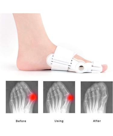 Bale Toe Corrector & Protector - Orthopedic Relief for Hallux Valgus & Hammer Toe - Buy Online on GoSupps.com