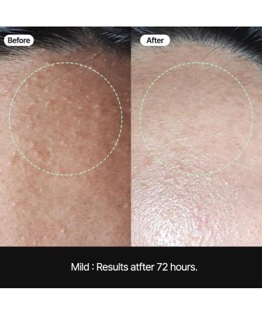 Comedones Soonsak Patch Super Mild - 50 Sheets for Gentle Sebum Removal | Innovative Skincare Technology - Buy Online on GoSupps.com