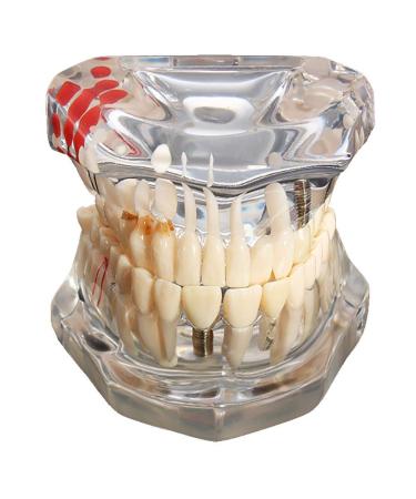 ERNZI Implant Dental Disease Teeth Model With Restoration Bridge Dentist For Science Study Tool