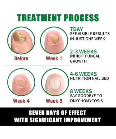 dizhenhui104jiaju LYEAA Nail fungus treatment 7 days nail fungus treatment toenails cuticle care oil ginger nail serum nail strengthening oil for damaged nails 2 pieces - Buy Online on GoSupps.com