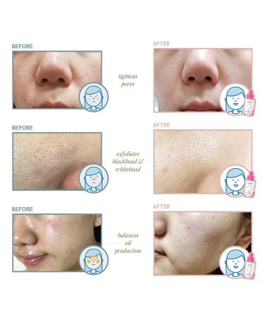 beplain 0.2% Salicylic Acid Serum - BHA Exfoliating Serum for Pore Refining Oil Control & Acne Treatment | Korean Skincare 1.01 fl. oz - Buy Online on GoSupps.com