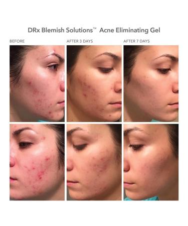 Dr Dennis Gross DRx Blemish Solutions Acne Eliminating Gel - 1.0 fl oz - Buy Online on GoSupps.com