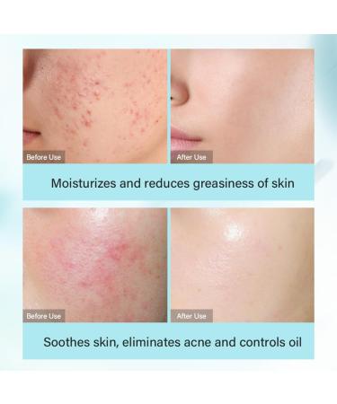 Tea Tree Acne Skin Care Kit for Oily Skin 4 Step Acne Treatment Refreshing Oil Control Nourishes Skin Travel Size with Face Cleanser - Buy Online on GoSupps.com