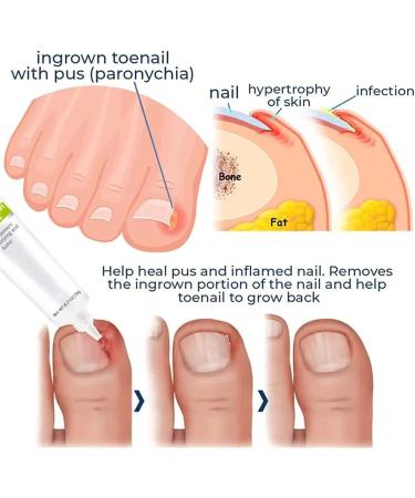 DUBUSH 2023 Removal Paronychia Gel Nail Nail Treatment Repair Gel Instant Beauty Gel for Nail Growth Care Anti Paronychia Relief Cream Toe and Fingernail Repair 5 pieces - Buy Online on GoSupps.com