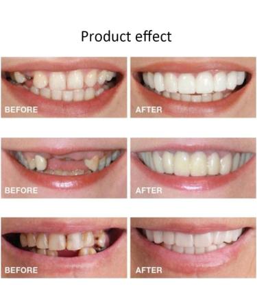 Xzlzmd Pebble Gel Dental Prostheses - Natural Color Temporary Veneers for Cracked or Missing Teeth (5 Pairs) - Immediate Repair for Men and Women - Buy Online on GoSupps.com