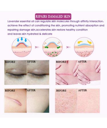 Allbesta Scar Repair Serum - Lavender Essence Essential Oil for Acne Burn & Stretch Marks Removal | Natural Skin Care 10ML - Buy Online on GoSupps.com
