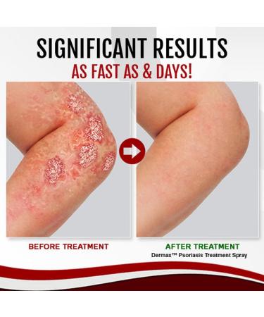 Dermax Psoriasis Treatment Spray 30ml - Soothe Skin, 5 Pack - Buy Online on GoSupps.com