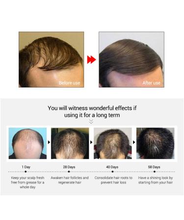 Hair Growth Essence Oil for Men & Women - 20ml Thickening Tonic | Anti Hair Loss & Growth Accelerator - Buy Online on GoSupps.com