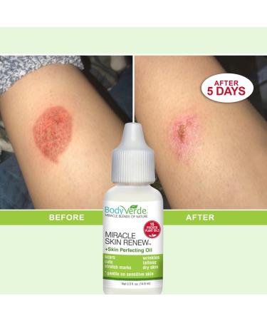 BodyVerde 100% Natural Miracle Skin Renew (Incredible multipurpose serum to support rapid skin healing in children and adults) - Buy Online on GoSupps.com