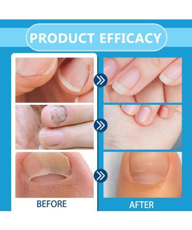 OIXYAZ OIXYA 2pack foot care spray antifungal and nail repairing nail care Nourishes the skin and nails Promotes a better foot climate 100 ml - Buy Online on GoSupps.com