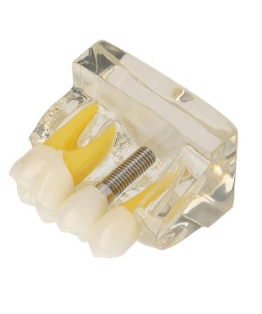 Transparent Tooth & Dental Implant Model | High Accuracy Resin | Effective Demonstration | International Shipping - Buy Online on GoSupps.com