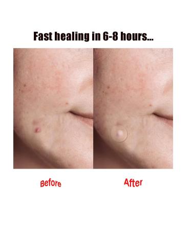 Hydrocolloid Acne Patches for Face | Effective Pimple Treatment | International Shipping - Buy Online on GoSupps.com