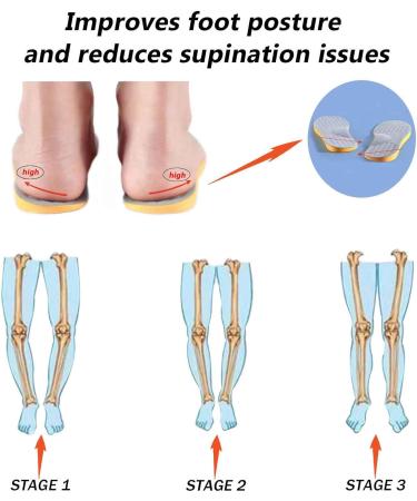 Supination Correction Insoles for Men & Women - Orthotic Inserts for Over-Supination Relief | Supportive Sole Inserts for Active Lifestyles - Size MEN 9-9.5/WOMEN 11-11.5 - Buy Online on GoSupps.com