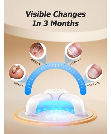 Nail Fungus Light Device for Fast Home Treatment | Repair Discolored Nails & Treat Onychomycosis Safely - International Shipping Available - Buy Online on GoSupps.com