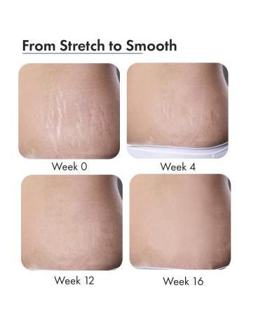 Anveya Stretch Marks Expert Serum Cream | Prevents & Reduces Appearance of New (Red) and Old (White) Stretchmarks | Powered by Striover Rosehip Oil & Squalane | Vegan and Cruelty-free | For Men - Buy Online on GoSupps.com