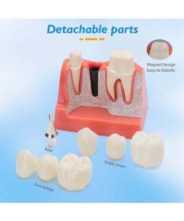 Dental Implant Model - 4 Times Removable Crown Bridge | Educational Teeth Model for Learning & Analysis - Buy Online on GoSupps.com