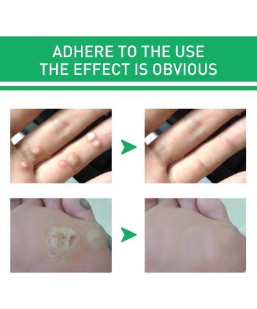 WATSKY Skin softening and foot care fluid for removing warts and corns gentle hypoallergenic formula 10 ml pack of 3 - Buy Online on GoSupps.com