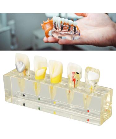 Professional Removable Zahnpulpa Model - Dental Endodontic Training Tool | Stable Resin for Students - Buy Online on GoSupps.com