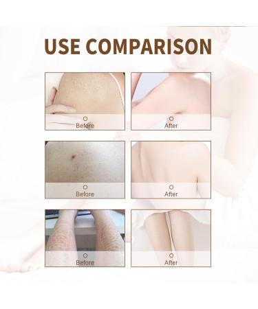 Keratosis Pilaris Lotion Chicken Skin Smoothing Cream Cream for Chicken Skin Repair Goosebump Repair Cream Scaly Skin Repair Cream Skin Care Body Cream for Chicken Skin Rough Bumpy Skin Body Lotion - Buy Online on GoSupps.com