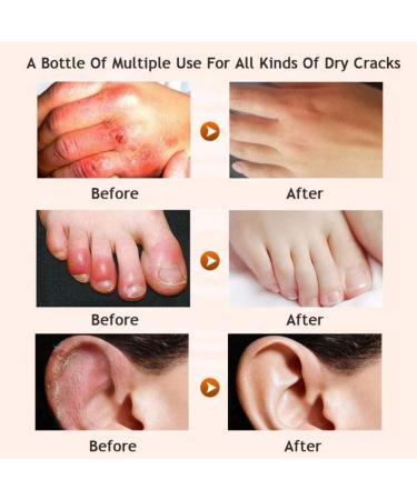 AllbestAye Foot Repair Cream - Heal Cracked Heels & Dry Feet | Moisturizing Callus Care for Soft Skin - 50g - Buy Online on GoSupps.com