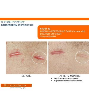  Strataderm Strataderm gel For professional scar therapy for old and new scars 5g - Buy Online on GoSupps.com