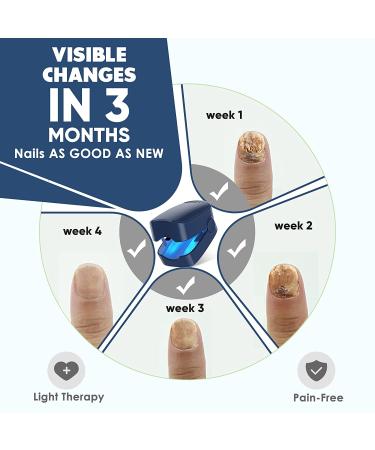Blue Nail Fungus Laser Treatment Device- Clip-on Design, Targets Damaged Toenails - Buy Online on GoSupps.com