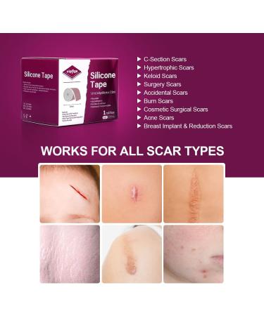 Medical Grade Reusable Silicone Scar Tape - 1.6 x 60 - Comfy & Painless Removal for Keloid, C-Section, Burn & Surgical Scars - Economy Roll - Buy Online on GoSupps.com