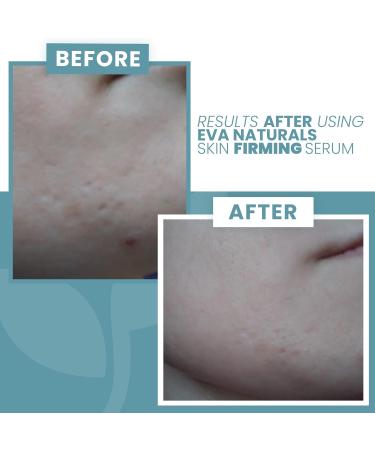 Skin Firming Serum with Niacinamide, Vitamin C, Hyaluronic Acid - Acne & Wrinkle Serum for Sensitive Skin - 1 Fl Oz - Buy Online on GoSupps.com