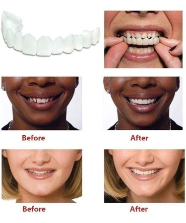 Giural 2 Pairs False Teeth Veneers - Instant Perfect Smile | Cosmetic Temporary Braces for Imperfect Teeth - Buy Online on GoSupps.com