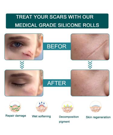 Medical Grade Silicone Scar Sheets 1.6x120 Inch - Reusable Tape Roll for Scar Removal on Face & Body - Surgery, C-Section, Keloid, Burn, Acne - Buy Online on GoSupps.com