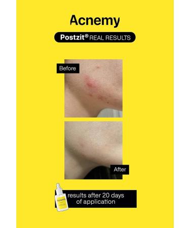  POSTZIT - Effective Zit Marks Solution for Clear Skin | International Shipping Available  - Buy Online on GoSupps.com