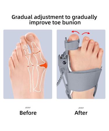 Bunion Corrector with Toe Spacers - Adjustable Big Toe Straightener for Effective Bunion Relief | Best Toe Separators for Women - Buy Online on GoSupps.com