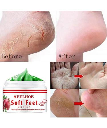 Frost Protection Cream for Feet | Anti-Crack Moisturizer & Dead Skin Foot Butter | Nourish & Repair with Effective Foot Care Cream - Buy Online on GoSupps.com