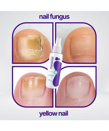 Medinail Fungus Spray - Advanced Nail Fungus Treatment and Strengthener 3.38 Fl Oz - Buy Online on GoSupps.com